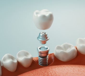 dental implant model