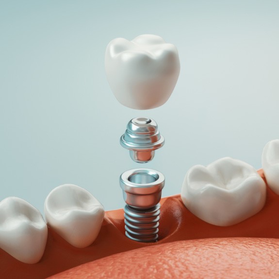 dental implant model